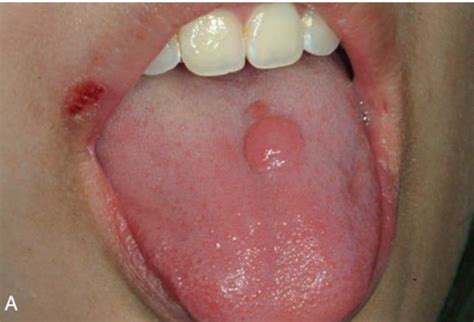 Lymphoma Of Tongue Medizzy