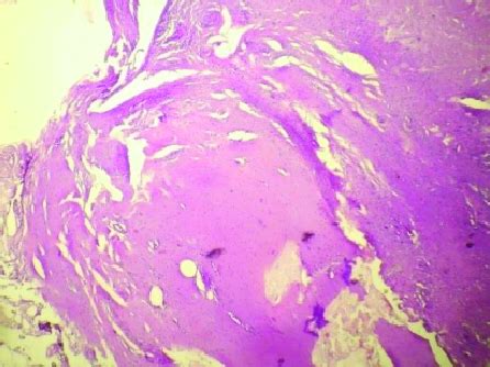 Histopathological examination results Note: The arrow indicates fibrous ... 