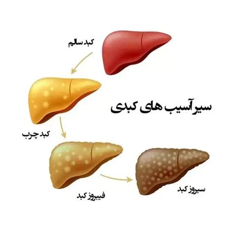 آزمایش کبد چرب چیست و کبد چرب چه علائمی دارد؟ آزمایشگاه ثمره