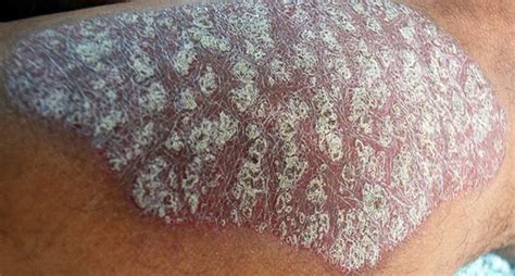 АСД фракция 2 при псориазе – инструкция по применению. Псориаз — не ...