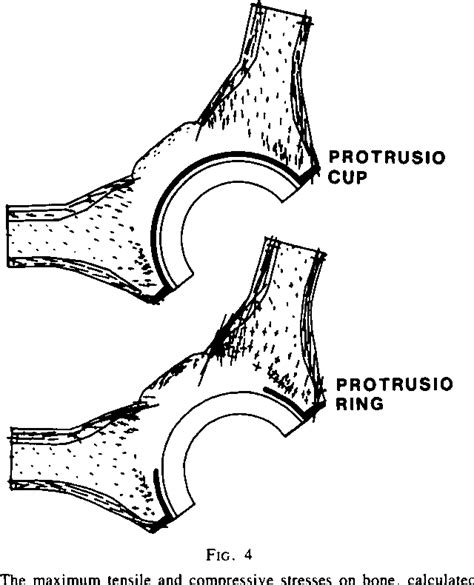 Protrusio Acetabuli Semantic Scholar