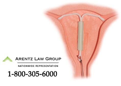 How Mirena Iud Works