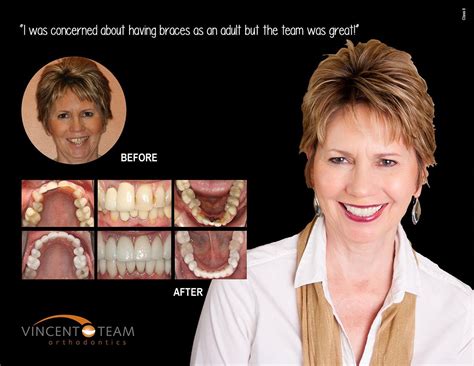 Smiles Gallery Vincent Team Orthodontics