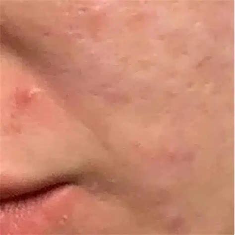 Morpheus 8 Acne Scar Treatment In Nyc Skinney Medspa