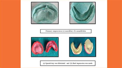 Treatment Of Hypohidrotic Ectodermal Dysplasia TMU News