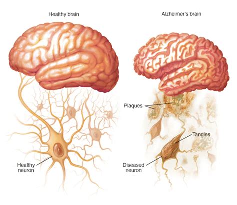 Silo Pharma Advances Alzheimer’s Disease Treatment with SPC-14 - The Dales Report