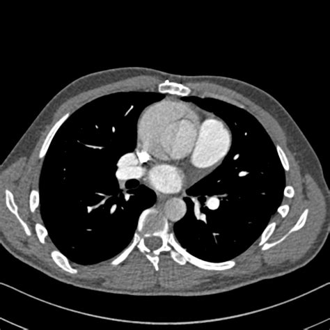 File Marfan Syndrome With Ascending Aortic Aneurysm And Stanford A