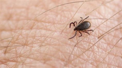 Lyme Disease Can Be Diagnosed By Bulls Eye Rash Alone Bbc News