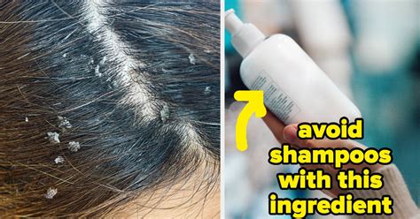 Tips To Treat A Dry Scalp And Dandruff In The Winter