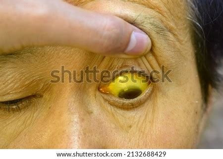 SCLERA Stock Photos and Images - Avopix.com