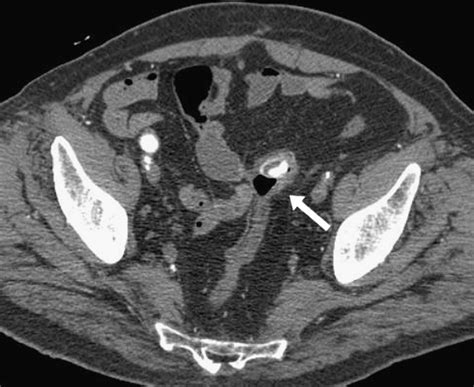 Iatrogenic Sigmoid Perforation By Aortobifemoral Left Graft Limb Surgery