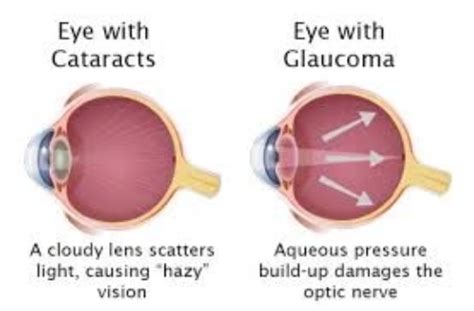 Differences Between Cataract And Glaucoma Axis Eye Clinic