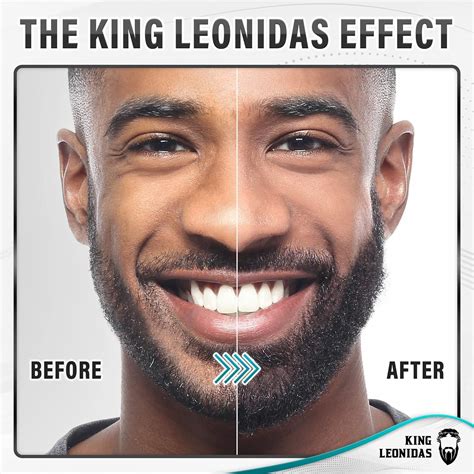 King Leonidas Beard Derma Roller Mm Titanium Micro Needling For Men