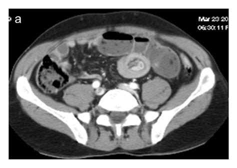 Enteroenteric Ileoileal Intussusception Secondary To Colic Download Scientific Diagram