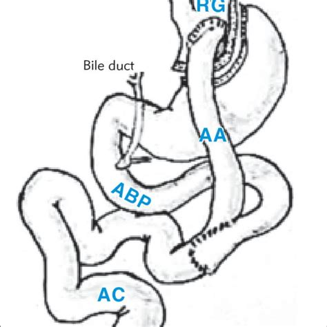 Roux En Y Gastric Bypass The Gastric Pouch Rg The Alimentary Limb