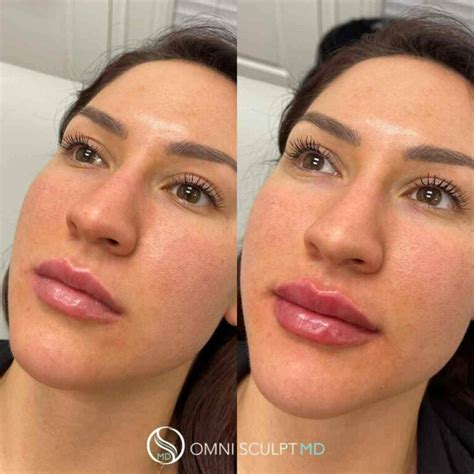 Lip Injection Before After Gallery OMNI SCULPT MD