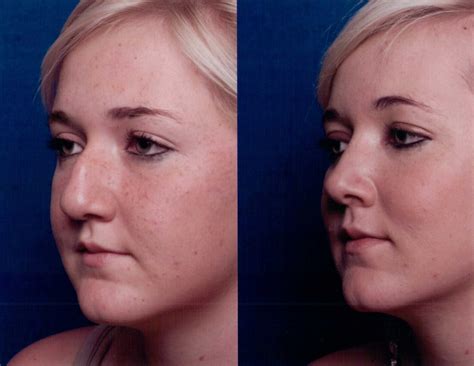 The Nose Clinic | BEFORE & AFTER NOSE SURGERY PHOTOS 55