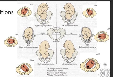 OB GYN Flashcards Quizlet