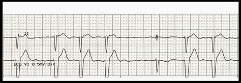 Practice EKG Rhythm Strips 210