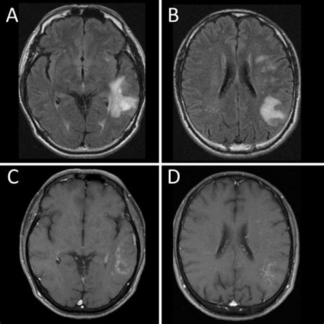 Figure Brain Mri Findings At Admission Fluid Attenuated Inversion