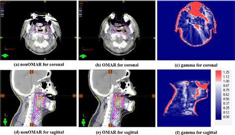 Comparison Of Volumetric Modulated Arc Therapy Treatment Plans For