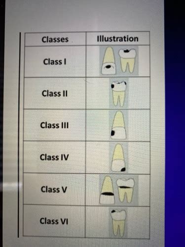 Charting Caries Flashcards Quizlet