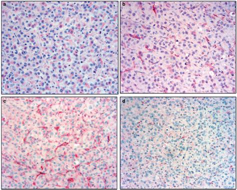 Staining Of Tumor Tissue For Upar A And B And Cd C And D In