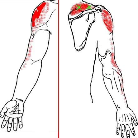 Supraspinatus Triggerpoint Online Emergencydentistry