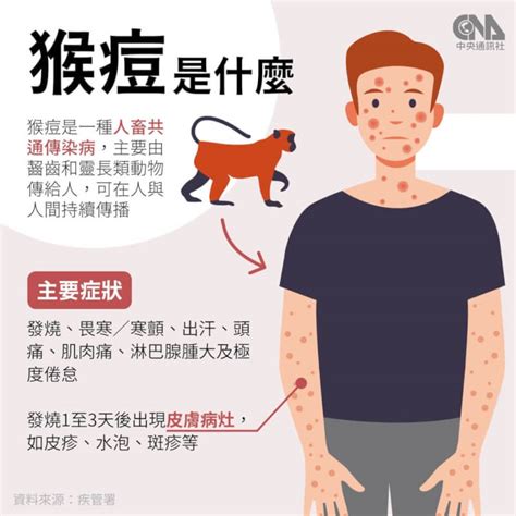 猴痘疫苗接種對象7月放寬 這3類人可打 生活 中央社 Cna