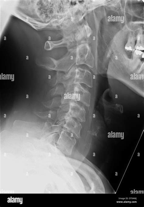 X-ray of human neck displays spine vertebrae Stock Photo - Alamy