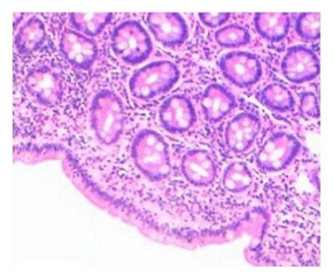 Duodenal Histopathological Features A B C Partial Villous Atrophy