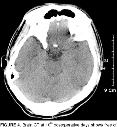 Figure 4 From Symptomatic Pneumocephalus After Spinal Intradural Tumor