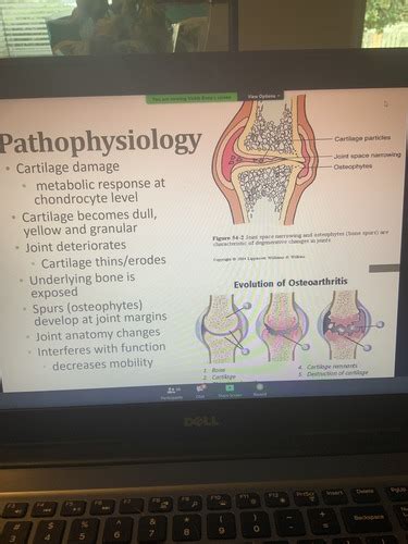 Osteoarthritis Flashcards Quizlet