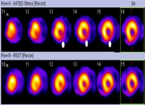 Nuclear Medicine Pet Scan Cardiovascular Assessment Protocols And