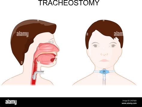 Tracheotomy Side View Of The Neck And Placement Of A Tracheostomy Tube