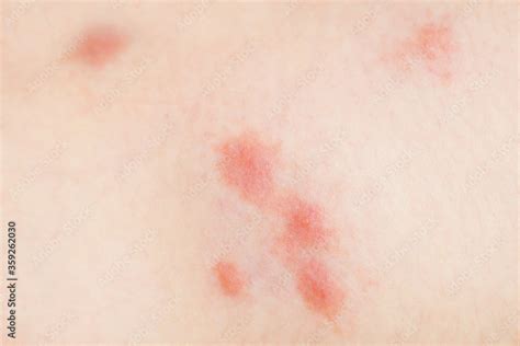 Allergy to insect bites, redness, swelling. Skin allergic reactions ...