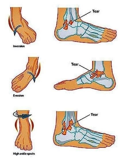 Ankle Sprain Types