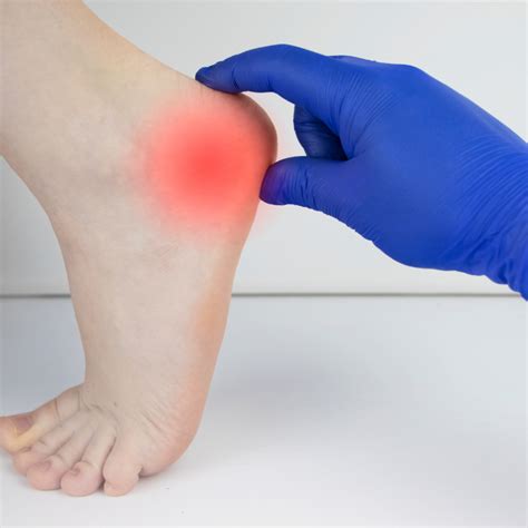 Heel Bursitis - Darwin Podiatry