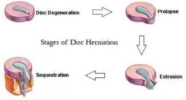 Treatment For Disc Prolapse Or Pivd Reliva Physiotherapy