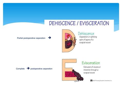 WOUND DEHISCENCE | PPT