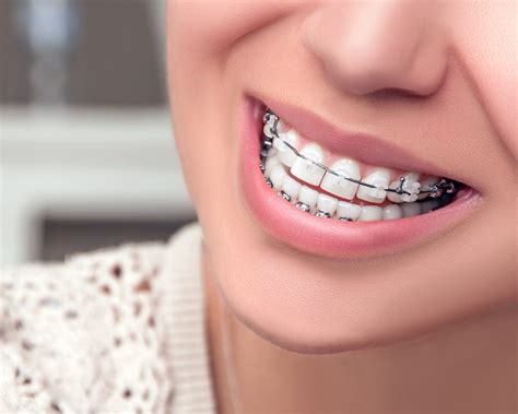 The Importance Of Dental Hygiene When Wearing Braces Dr Ltanya Joy