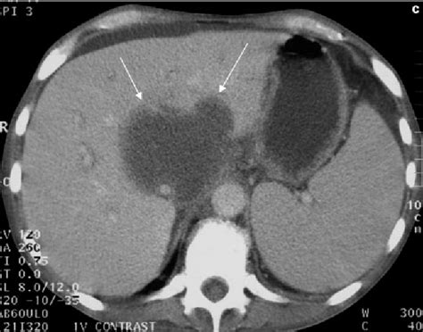 Figure From Percutaneous Radiofrequency Ablation Of Colorectal