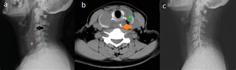 A X Ray Soft Tissue Neck Lateral View With Straightening Of Cervical Download Scientific