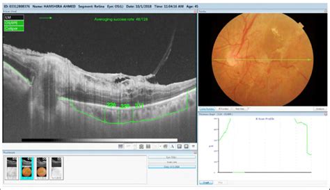 OCT image of a diabetic patient having PDR with DME illustrating ...