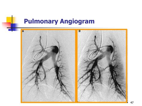 Ppt Pulmonary Embolism Powerpoint Presentation Free Download Id 9683549