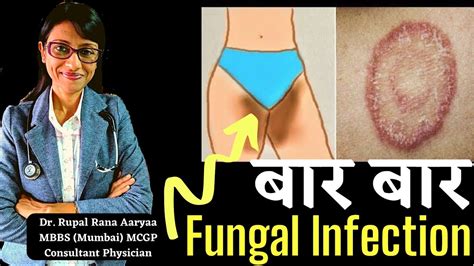 Private Parts 🤫 Mein Baar Baar Fungal Infection Hota Hai 😞 Treatment Of Recurrent Fungal