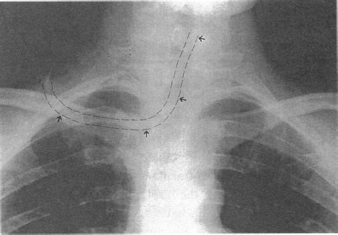 External Jugular Vein Cannulation