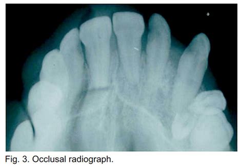 PDF: Peripheral Ossifying Fibroma ­ A Clinical Report