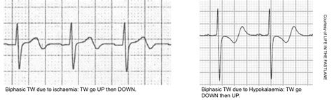 Acute Myocardial Infarction A Shifting Paradigm Recapem