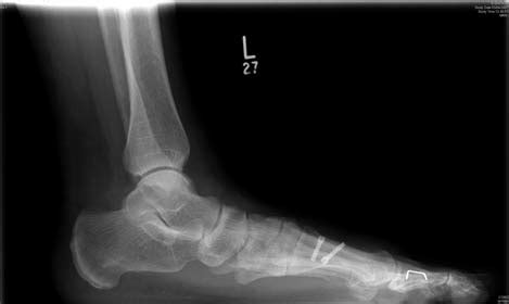 Ludloff Osteotomy Preoperatively A And At Months B And C